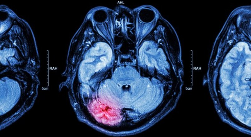 Daño Cerebral: Tratamiento y Compensación Indemnizatoria